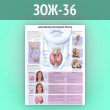 Плакат «Заболевания щитовидной железы» (ЗОЖ-36, ламинированная бумага, А2, 1 лист)